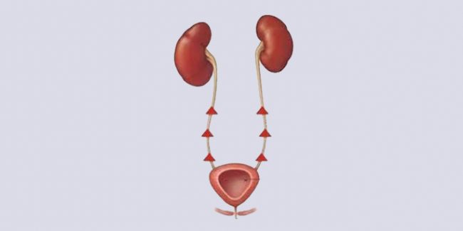 Vezikoüreteral reflü-2